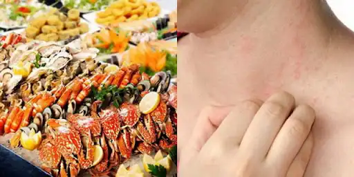 Dị ứng hải sản